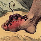 Gout toe of the foot