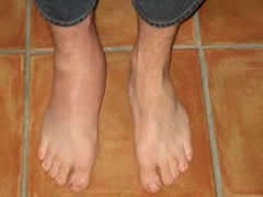 Gout toe of the foot