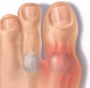 Gout toe