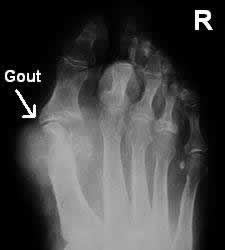 Gout toe radiography